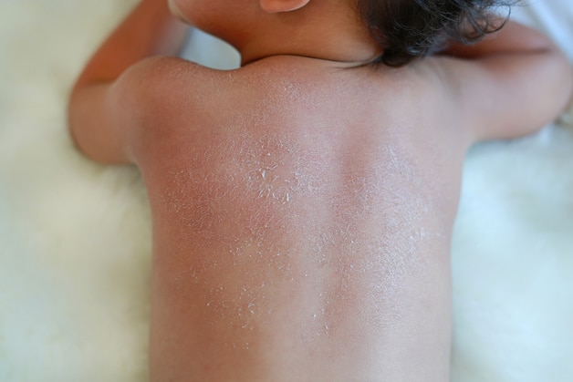 Criança deitada de costas mostrando a pele do bebê ressecada, com descamação visível e textura áspera na região dos ombros e costas.