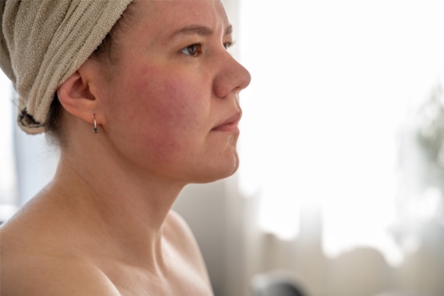 Mulher com manchas avermelhadas na pele do rosto e pescoço associadas à pitiríase versicolor.