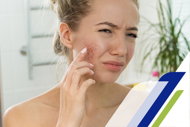 Girl worried about a pimple on her face Girl worried about a pimple on her face