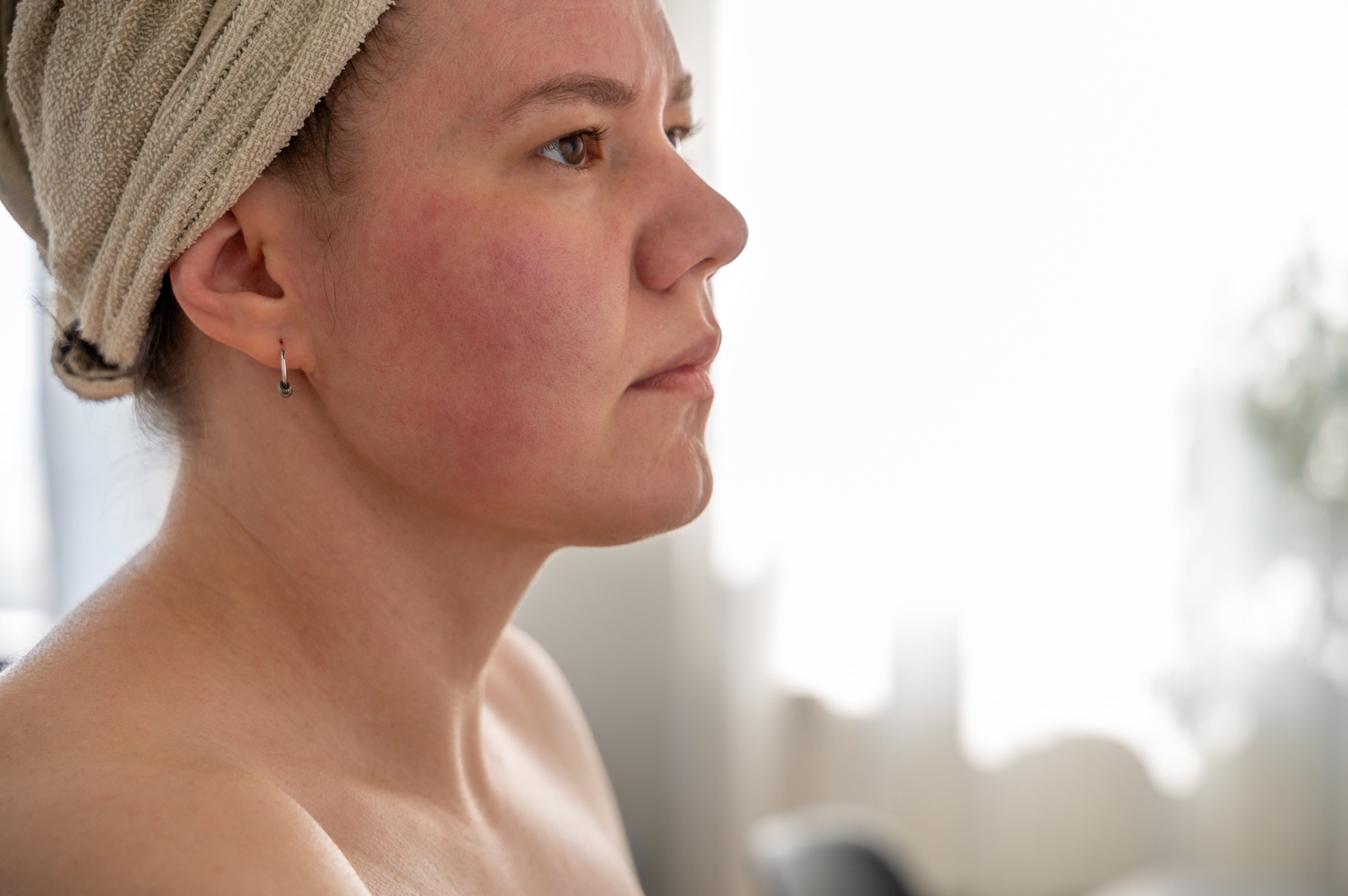 Mulher de perfil mostrando as bochechas avermelhadas devido a uma alergia ou condição dermatológica, representando a pele com urticária Mulher de perfil mostrando as bochechas avermelhadas devido a uma alergia ou condição dermatológica, representando a pele com urticária